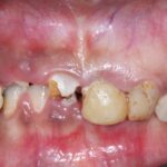 Patient's teeth before dental implants and restoration in Cairo, Egypt.
