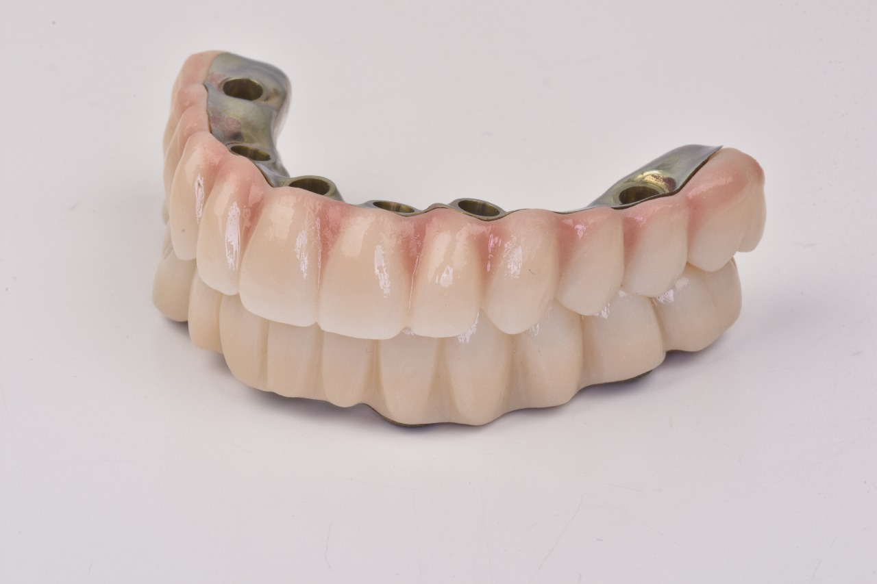 Dental implant prosthesis for full arch restoration.